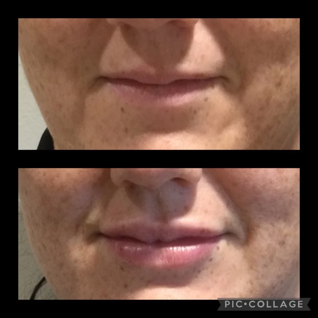 Two close-up photos of a persons mouth and lower face; the top image shows natural lips, while the bottom image shows fuller lips, suggesting a cosmetic enhancement or treatment.